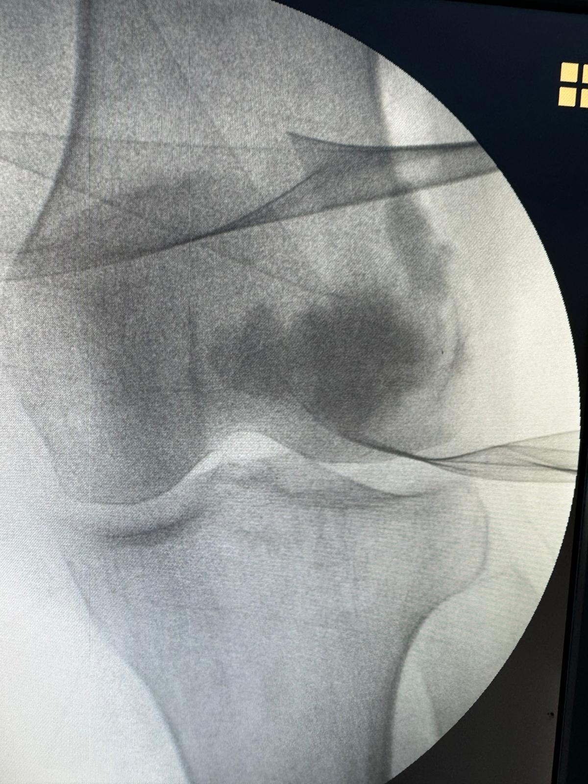 Vortrom Biologics FILLBONE