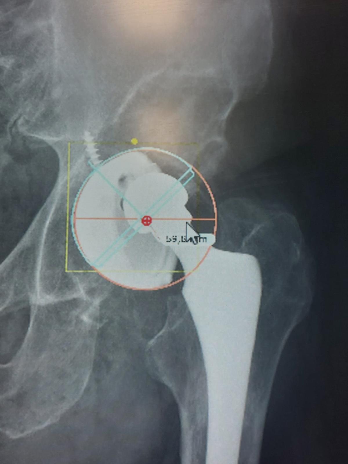 Vortrom Biologics FILLBONE