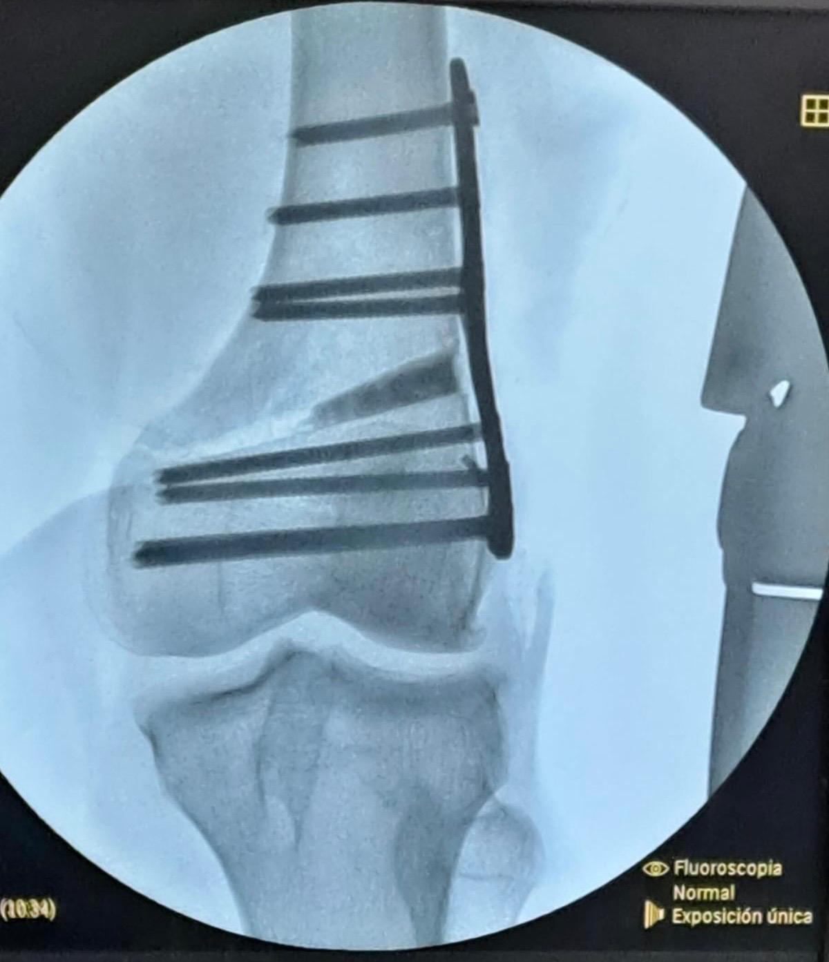 Vortrom Biologics FILLBONE